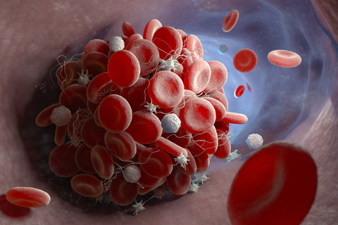 Ist eine Thrombose tödlich?